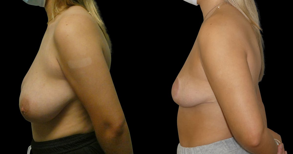 Breast Reduction Before & After Gallery - Patient 547442 - Image 4