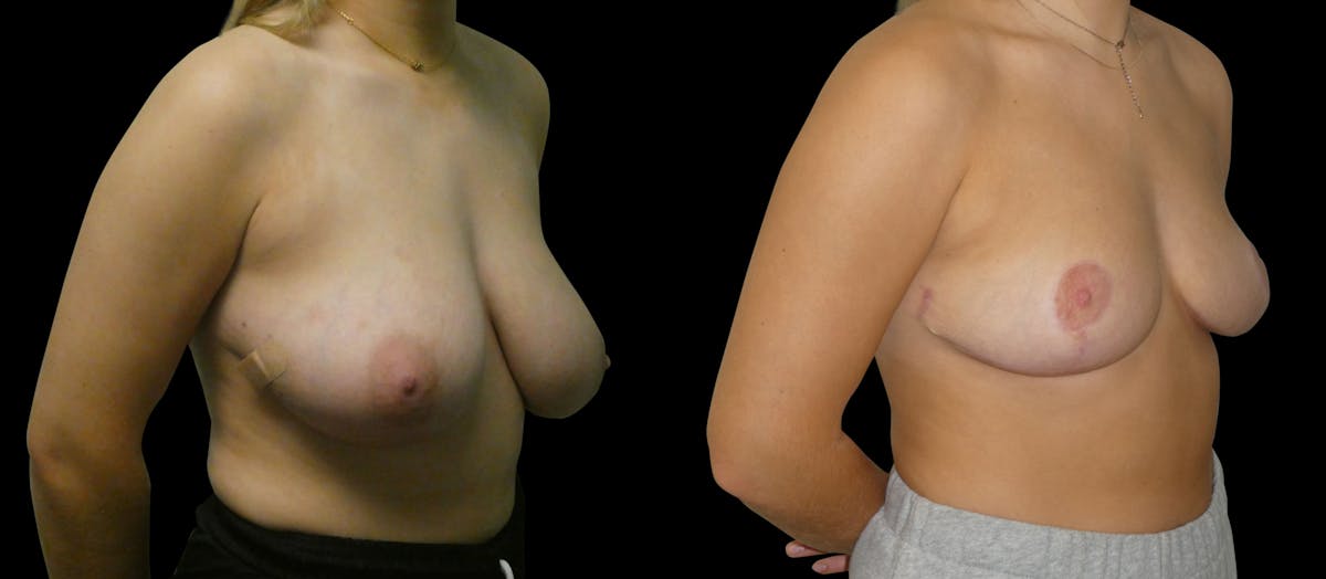 Breast Reduction Before & After Gallery - Patient 547442 - Image 2