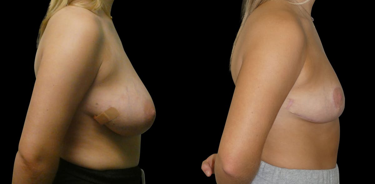 Breast Reduction Before & After Gallery - Patient 547442 - Image 5