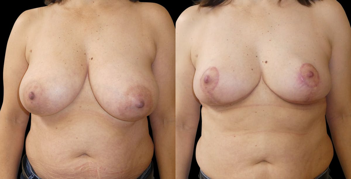 Breast Reduction Before & After Gallery - Patient 276048 - Image 1
