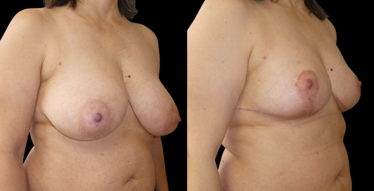 Breast Reduction Before & After Gallery - Patient 276048 - Image 2