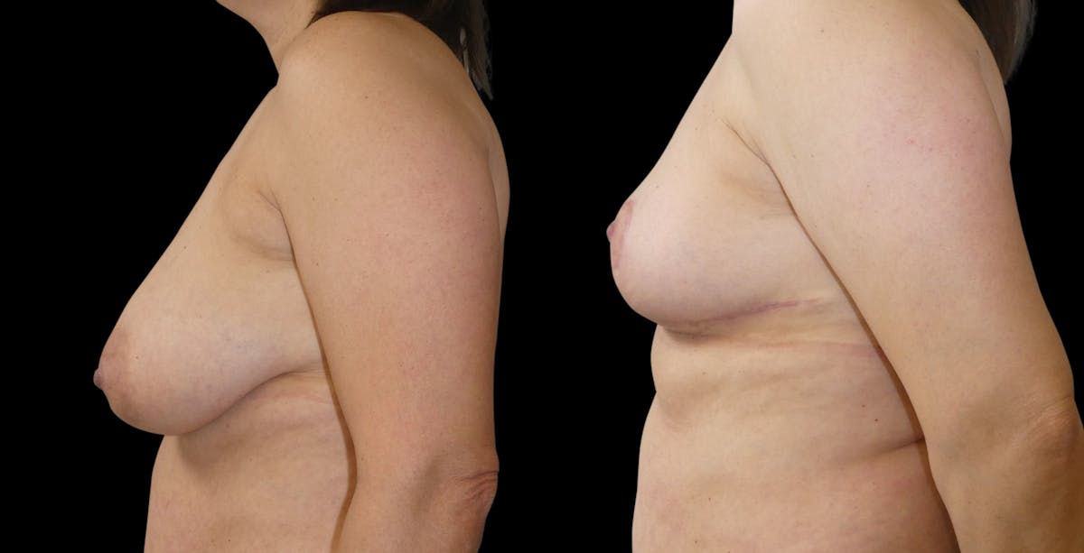 Breast Reduction Before & After Gallery - Patient 276048 - Image 4