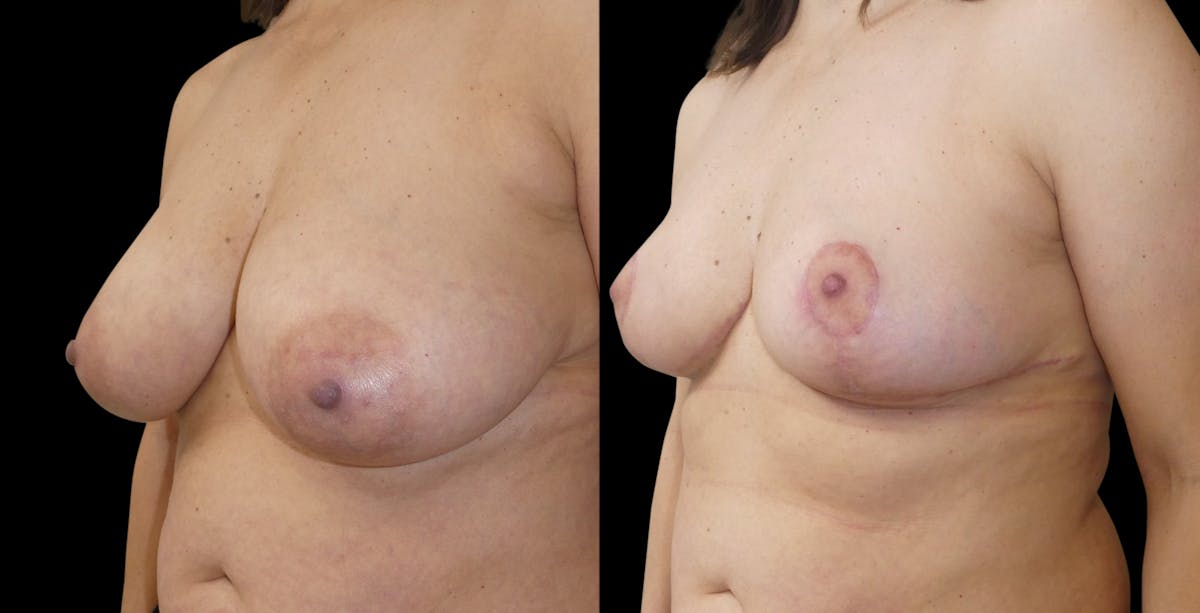 Breast Reduction Before & After Gallery - Patient 276048 - Image 3