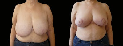 Breast Reduction Before & After Gallery - Patient 160800 - Image 1