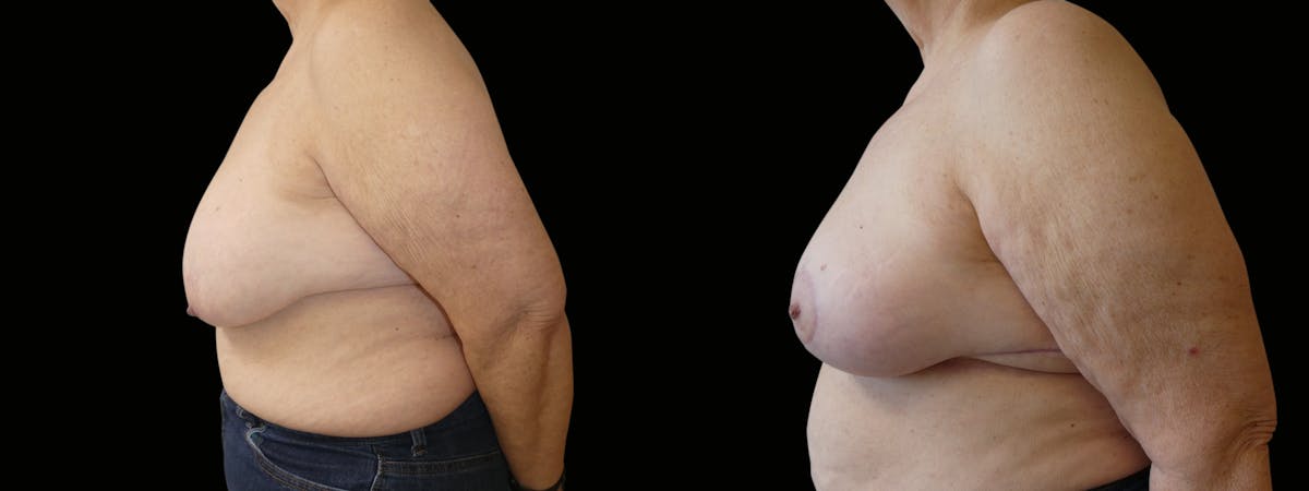 Breast Reduction Before & After Gallery - Patient 160800 - Image 4