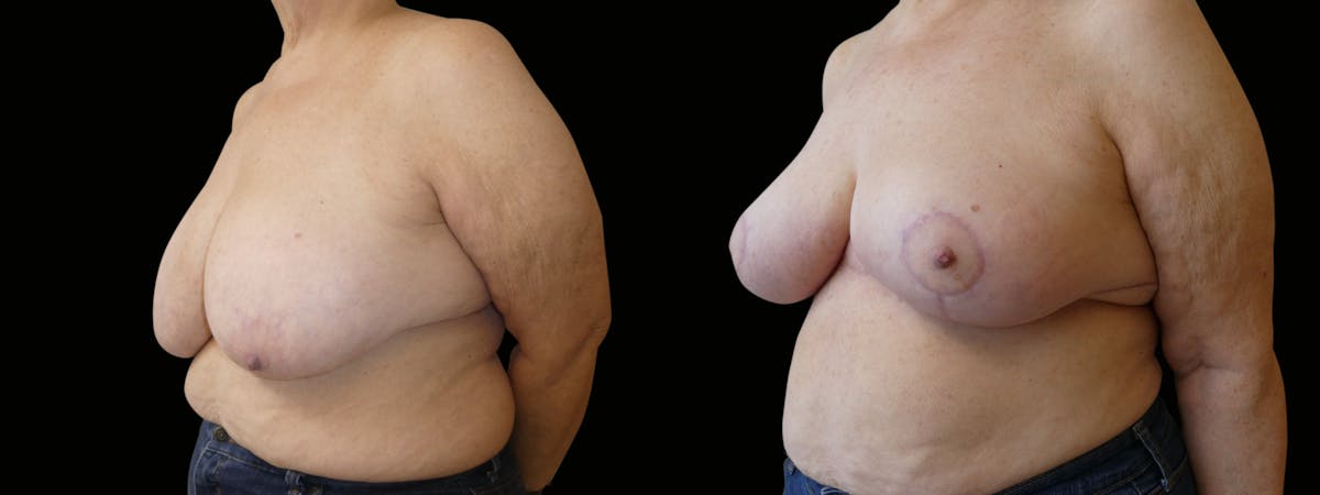 Breast Reduction Before & After Gallery - Patient 160800 - Image 3