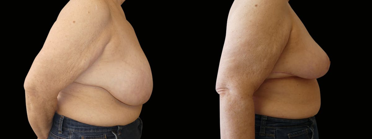 Breast Reduction Before & After Gallery - Patient 160800 - Image 5