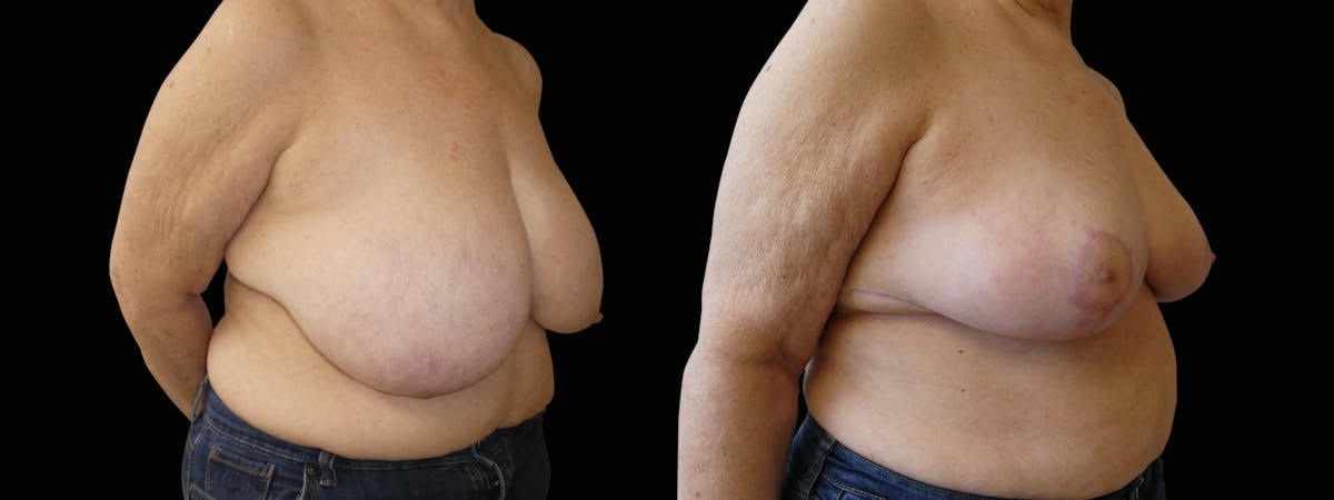Breast Reduction Before & After Gallery - Patient 160800 - Image 2