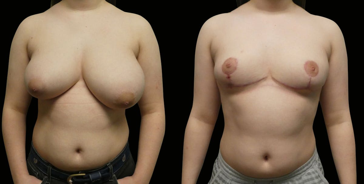 Breast Reduction Before & After Gallery - Patient 902132 - Image 1