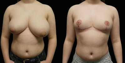 Breast Reduction Before & After Gallery - Patient 902132 - Image 1