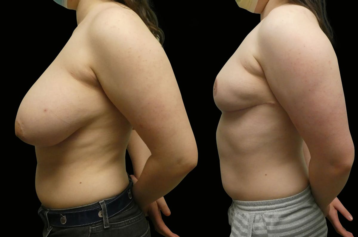 Breast Reduction Before & After Gallery - Patient 902132 - Image 2
