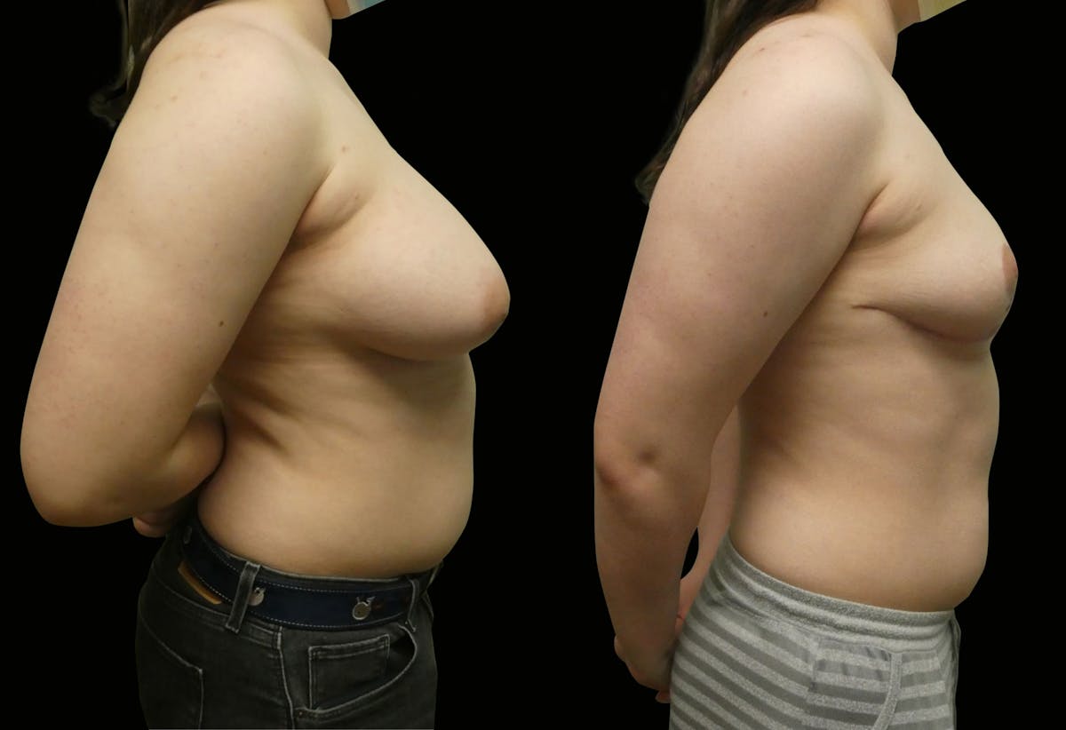Breast Reduction Before & After Gallery - Patient 902132 - Image 3