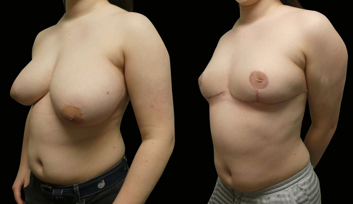 Breast Reduction Before & After Gallery - Patient 902132 - Image 5