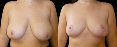 Breast Reduction + Lift Before & After Gallery - Patient 604625 - Image 1