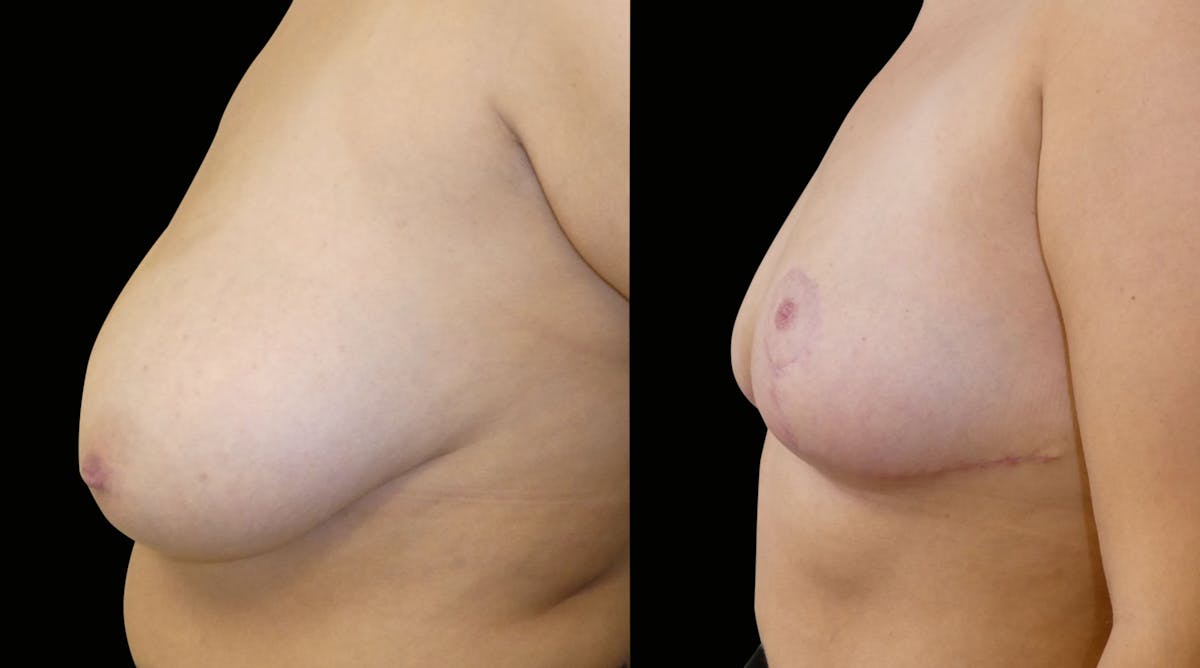 Breast Reduction Before & After Gallery - Patient 160020 - Image 5