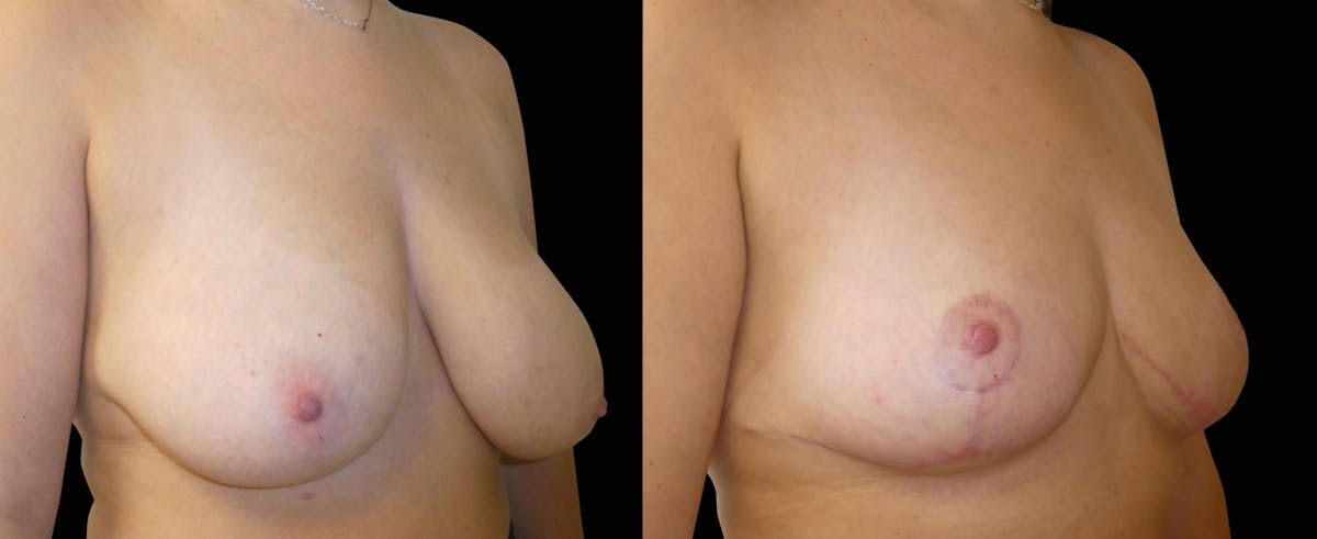 Breast Reduction Before & After Gallery - Patient 160020 - Image 3