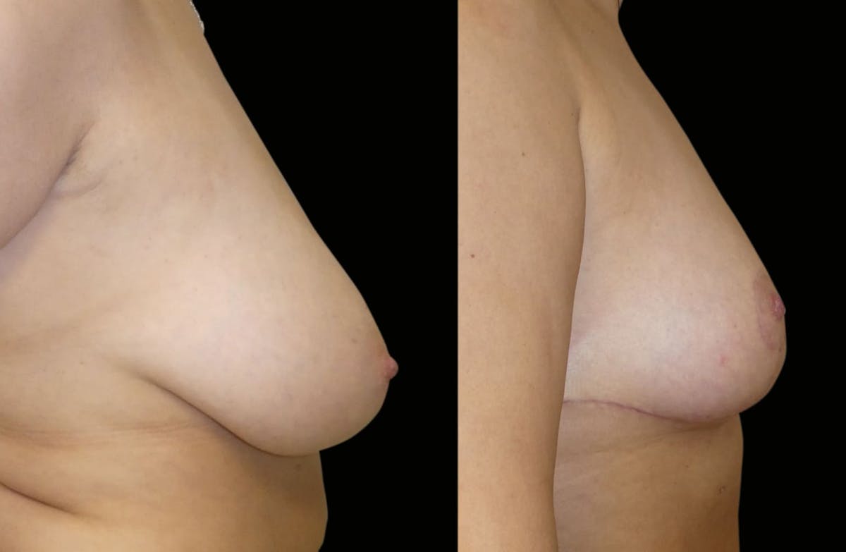 Breast Reduction Before & After Gallery - Patient 160020 - Image 4