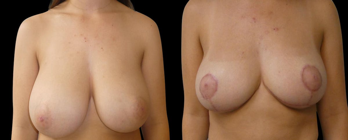 Breast Reduction + Lift Before & After Gallery - Patient 153106 - Image 1