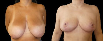 Breast Reduction + Lift Before & After Gallery - Patient 111910 - Image 1