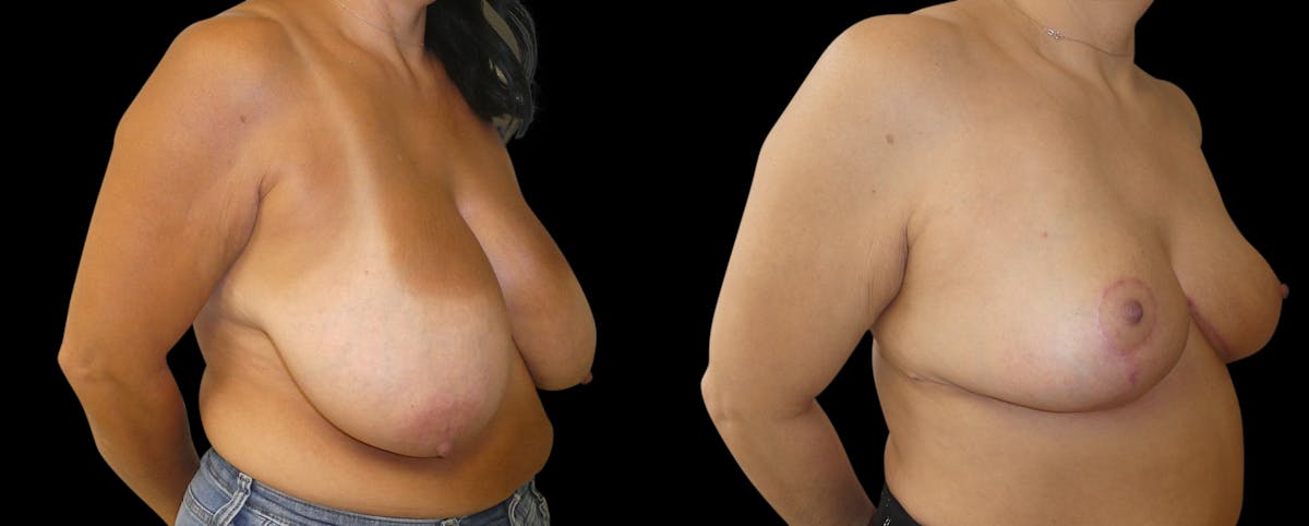 Breast Reduction + Lift Before & After Gallery - Patient 111910 - Image 3
