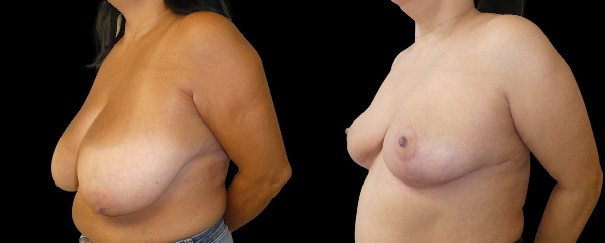 Breast Reduction + Lift Before & After Gallery - Patient 111910 - Image 2