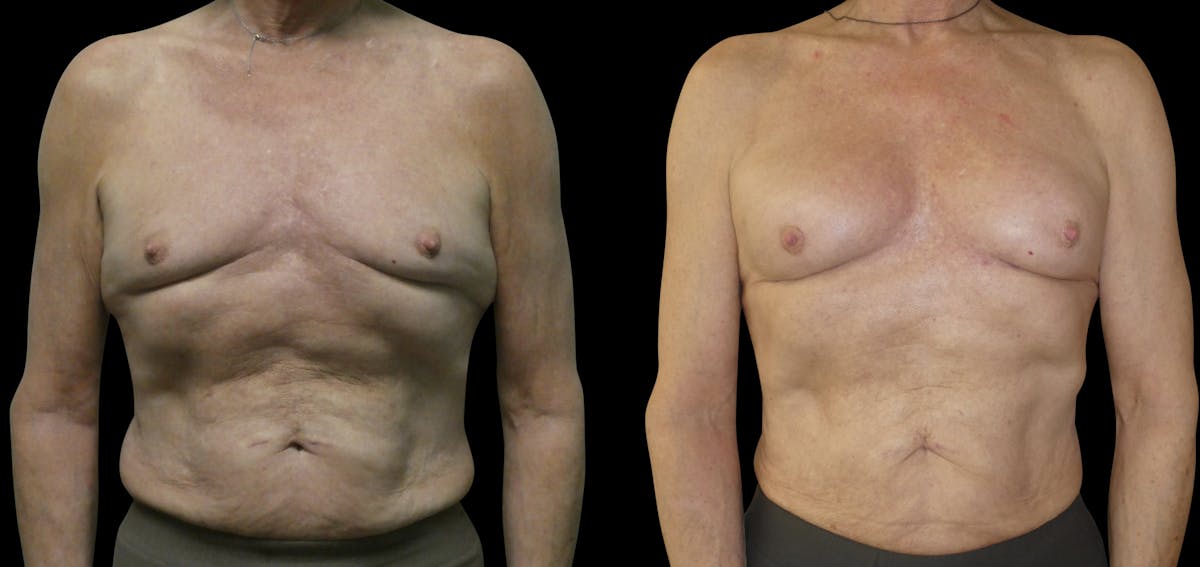 Breast Fat Grafting Before & After Gallery - Patient 226960 - Image 1