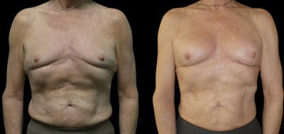 Breast Fat Grafting Before & After Gallery - Patient 226960 - Image 1