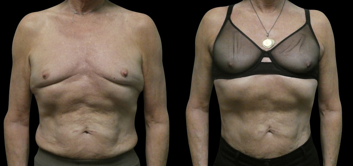 Breast Fat Grafting Before & After Gallery - Patient 226960 - Image 2