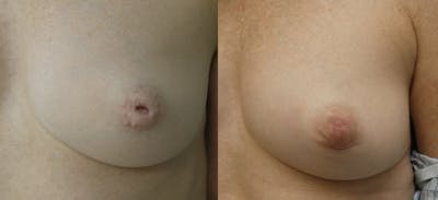 Inverted Nipple Repair Before & After Gallery - Patient 100125 - Image 1