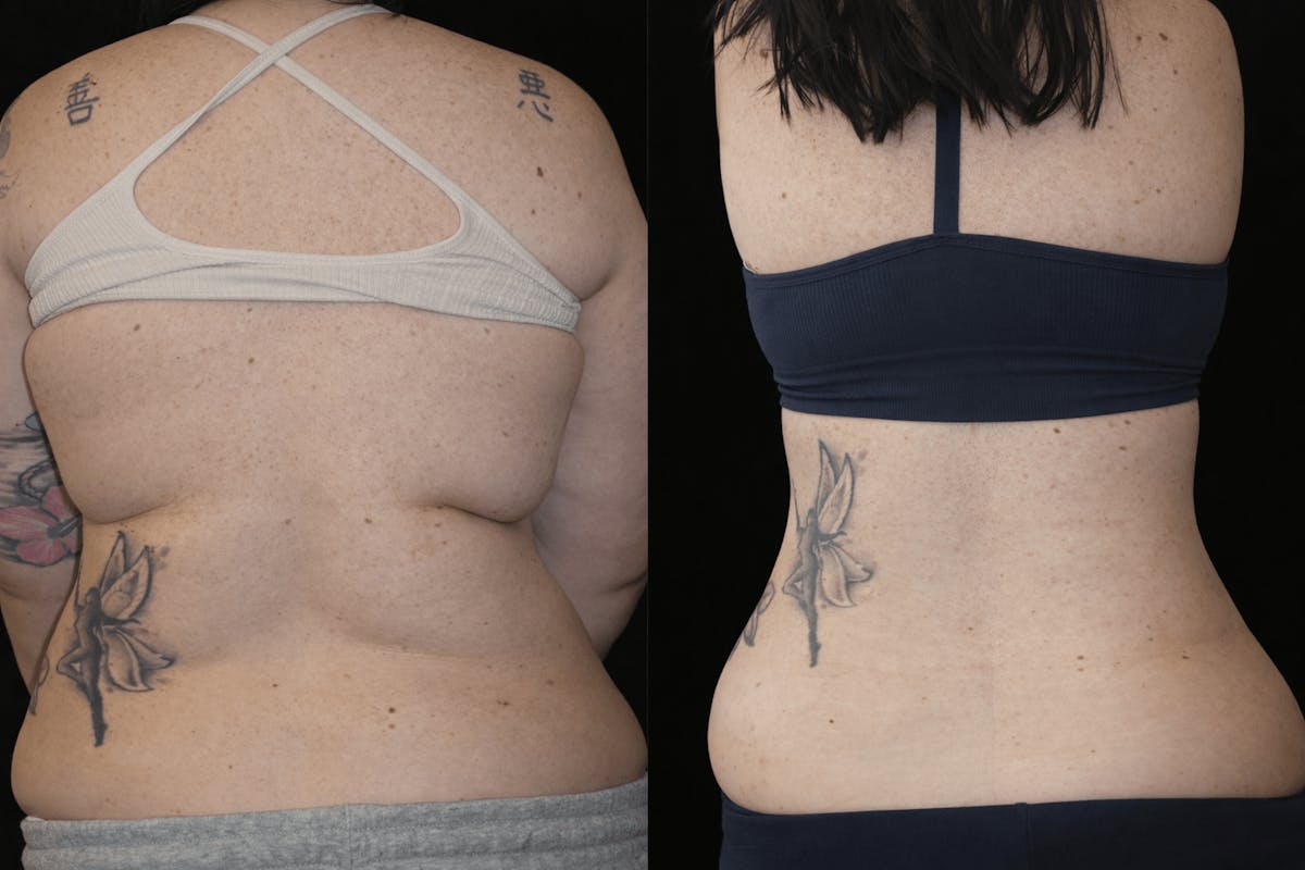 Liposuction Before & After Gallery - Patient 201087 - Image 6
