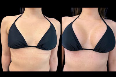 Breast Augmentation Before & After Gallery - Patient 265377 - Image 1