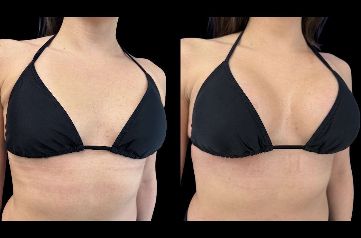 Breast Augmentation Before & After Gallery - Patient 265377 - Image 2
