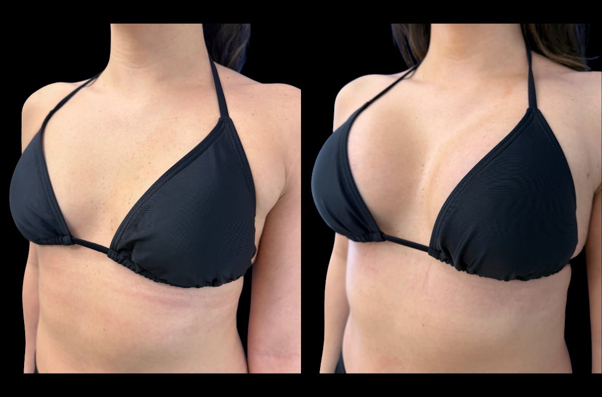 Breast Augmentation Before & After Gallery - Patient 265377 - Image 3