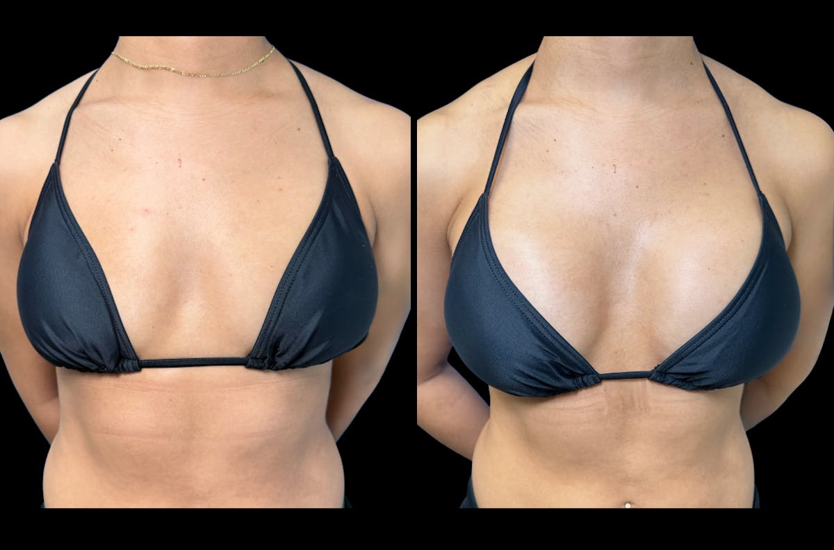 Breast Augmentation Before & After Gallery - Patient 279143 - Image 1