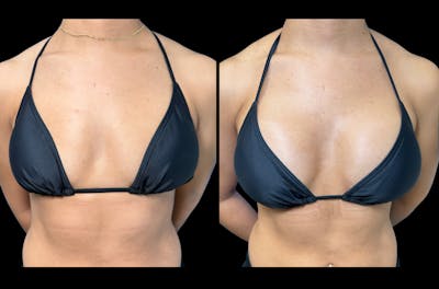 Breast Augmentation Before & After Gallery - Patient 279143 - Image 1
