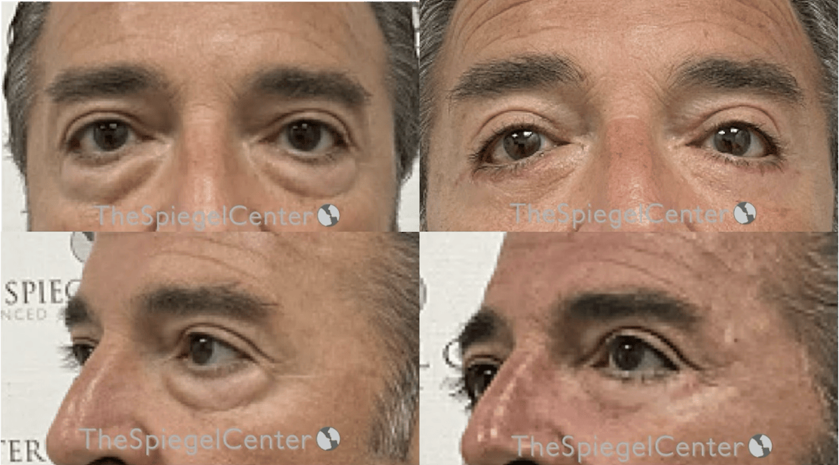 Blepharoplasty Before & After Gallery - Patient 155202 - Image 1