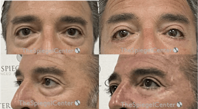 Blepharoplasty Before & After Gallery - Patient 155202 - Image 1