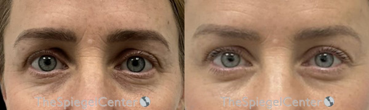 Browlift / Fox Eye Lift Before & After Gallery - Patient 251654 - Image 1
