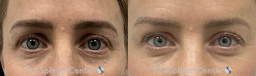 Brow Lift / Fox Eye Lift Before & After Gallery - Patient 251654 - Image 1