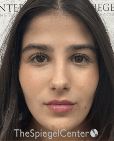 Buccal Fat Reduction Before & After Gallery - Patient 411408 - Image 2