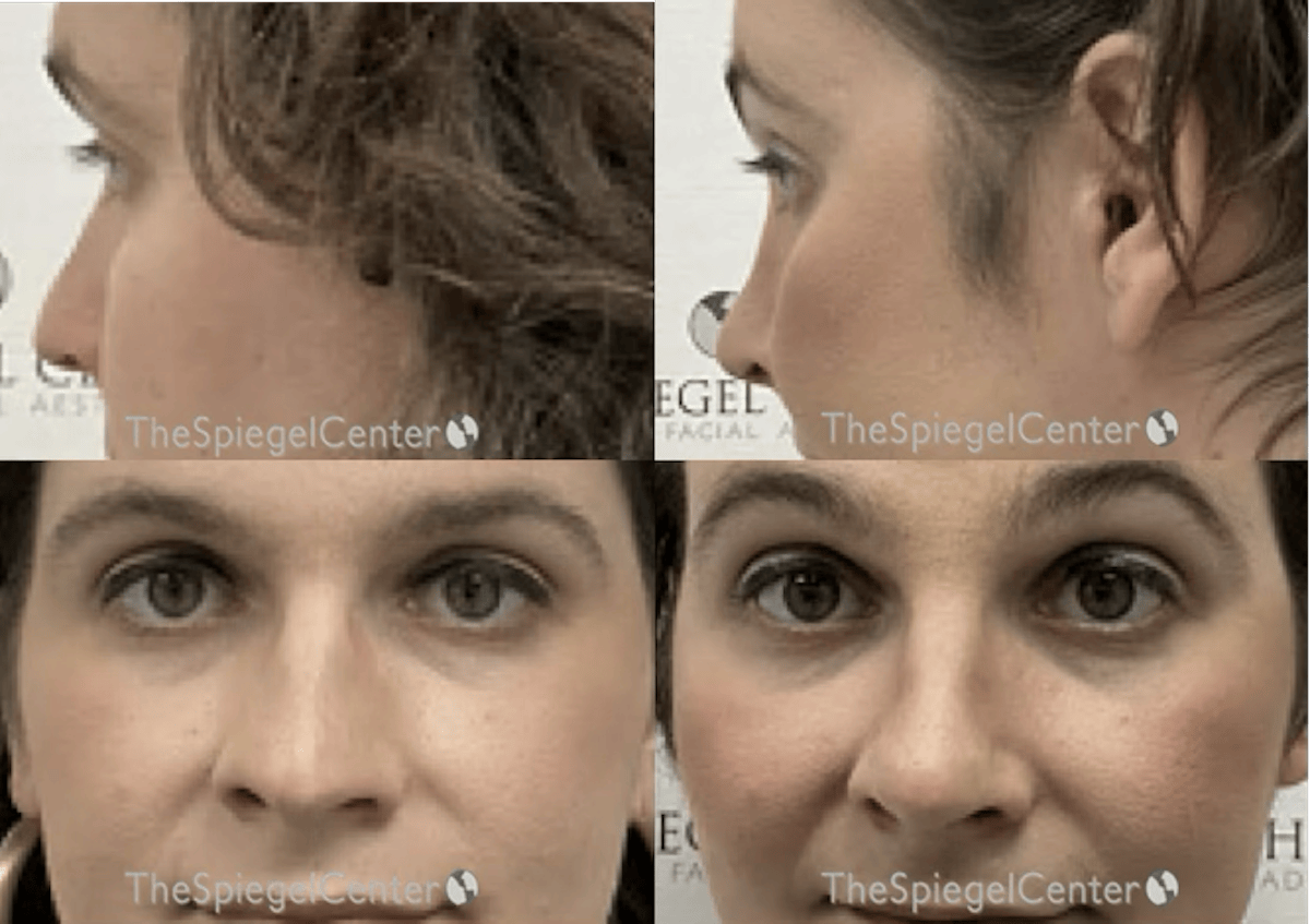 Cheek Implants Before & After Gallery - Patient 865764 - Image 1
