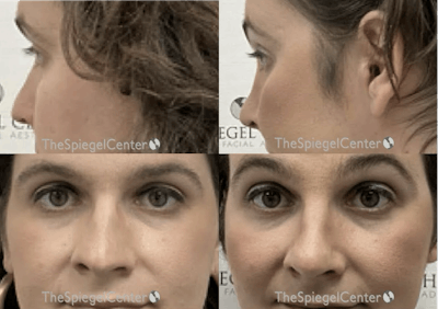 Cheek Implants Before & After Gallery - Patient 865764 - Image 1