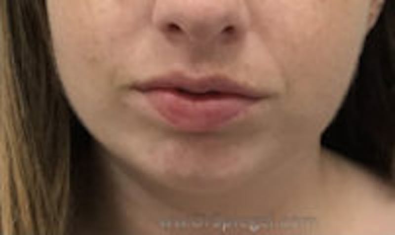 Chin Augmentation Before & After Gallery - Patient 103837 - Image 1