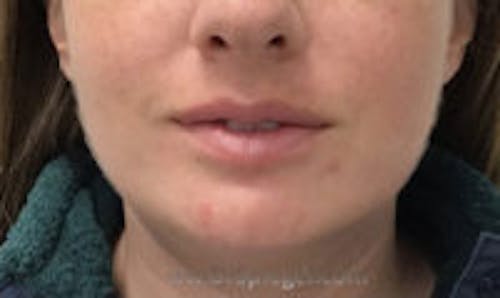 Chin Augmentation Before & After Gallery - Patient 103837 - Image 2