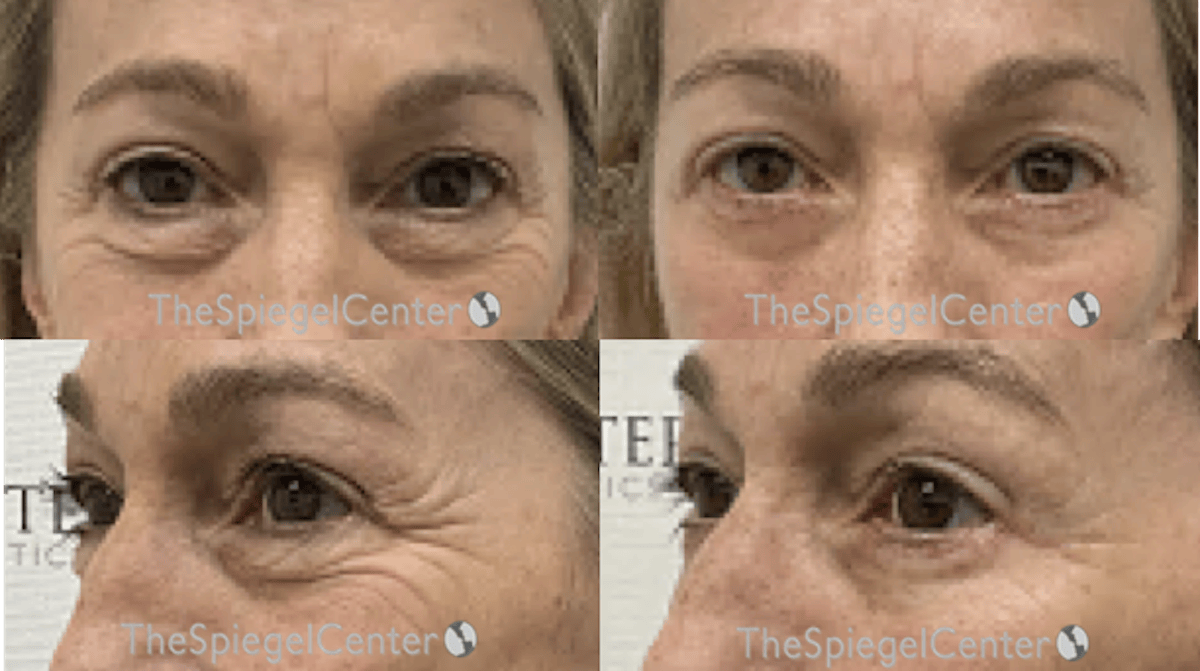 Blepharoplasty Before & After Gallery - Patient 174698 - Image 1