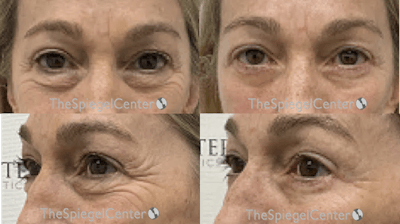 Blepharoplasty Before & After Gallery - Patient 174698 - Image 1