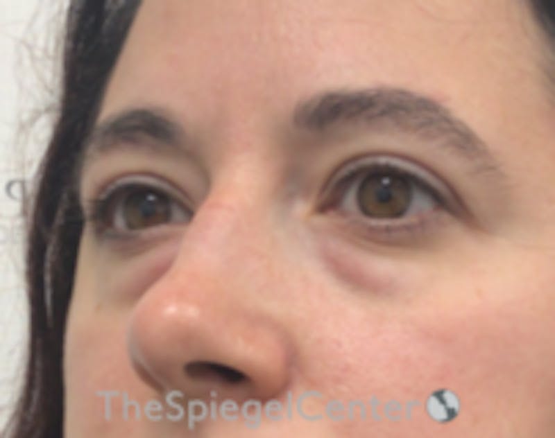 Blepharoplasty Before & After Gallery - Patient 264571 - Image 3