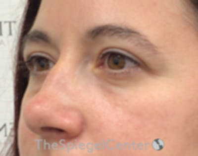 Blepharoplasty Before & After Gallery - Patient 264571 - Image 4
