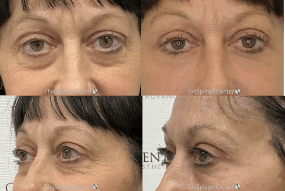 Blepharoplasty Before & After Gallery - Patient 309162 - Image 1