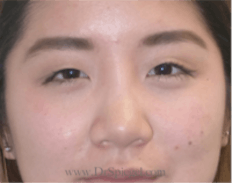 Blepharoplasty Before & After Gallery - Patient 143545 - Image 1